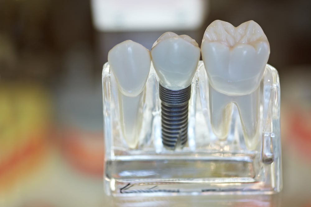 types-dental-bridges