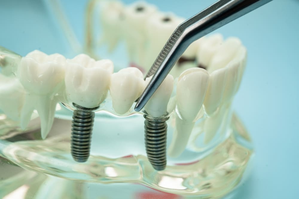 Dentures by Radiance Artistic Dental & Wellness Centre, Dr. Radip Uprety