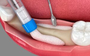 bone-grafting