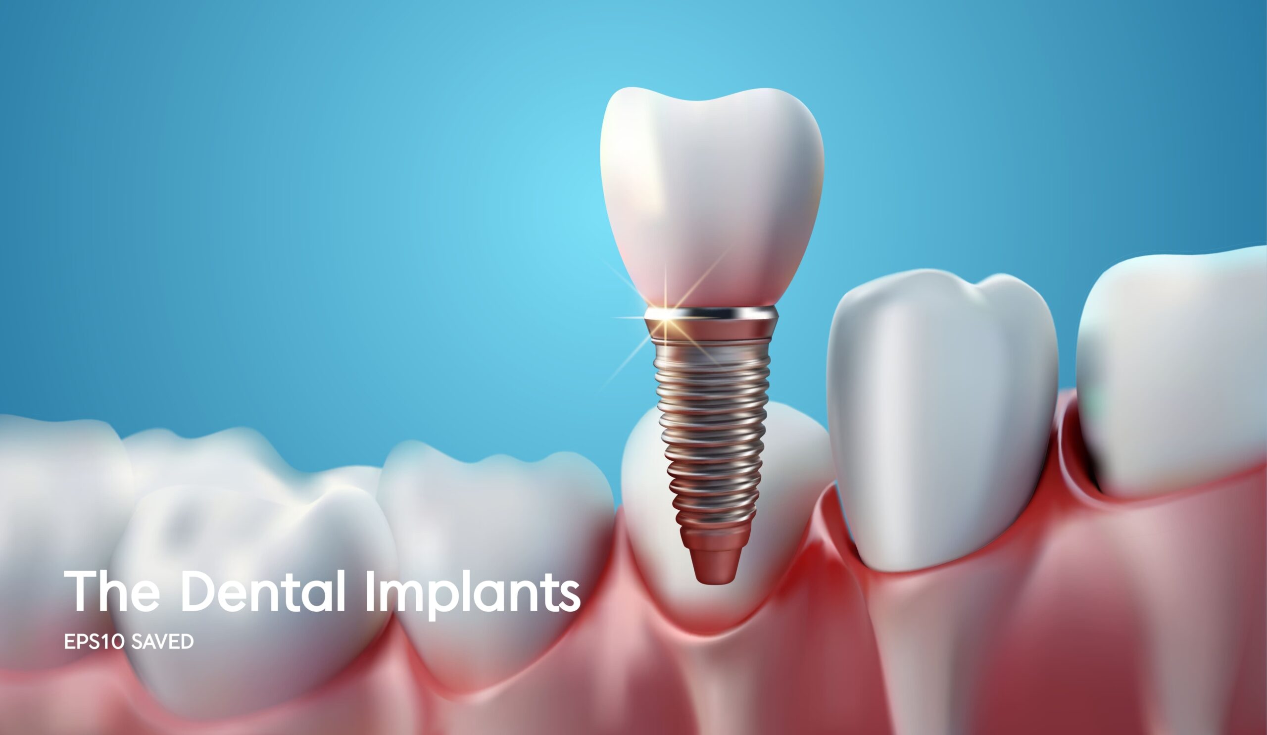 teeth-implant-procedure