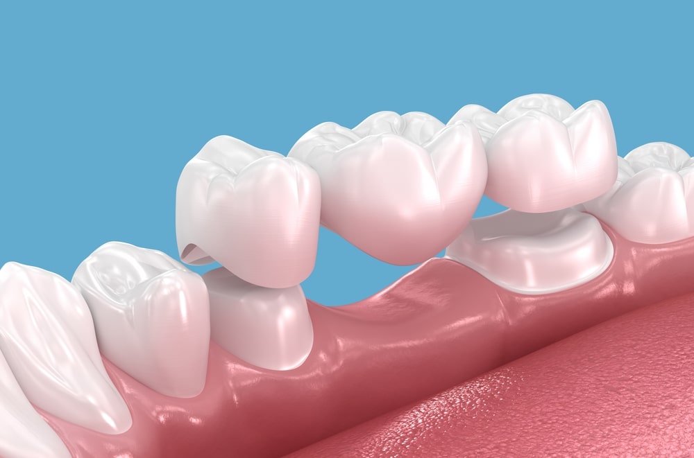 tooth-restoration-implant