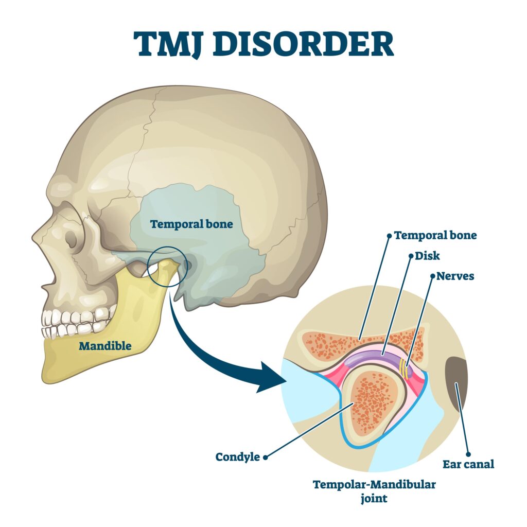 tmj-disorder-causes